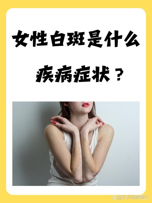 女人白斑妇科什么病:女人白斑妇科什么病会传染